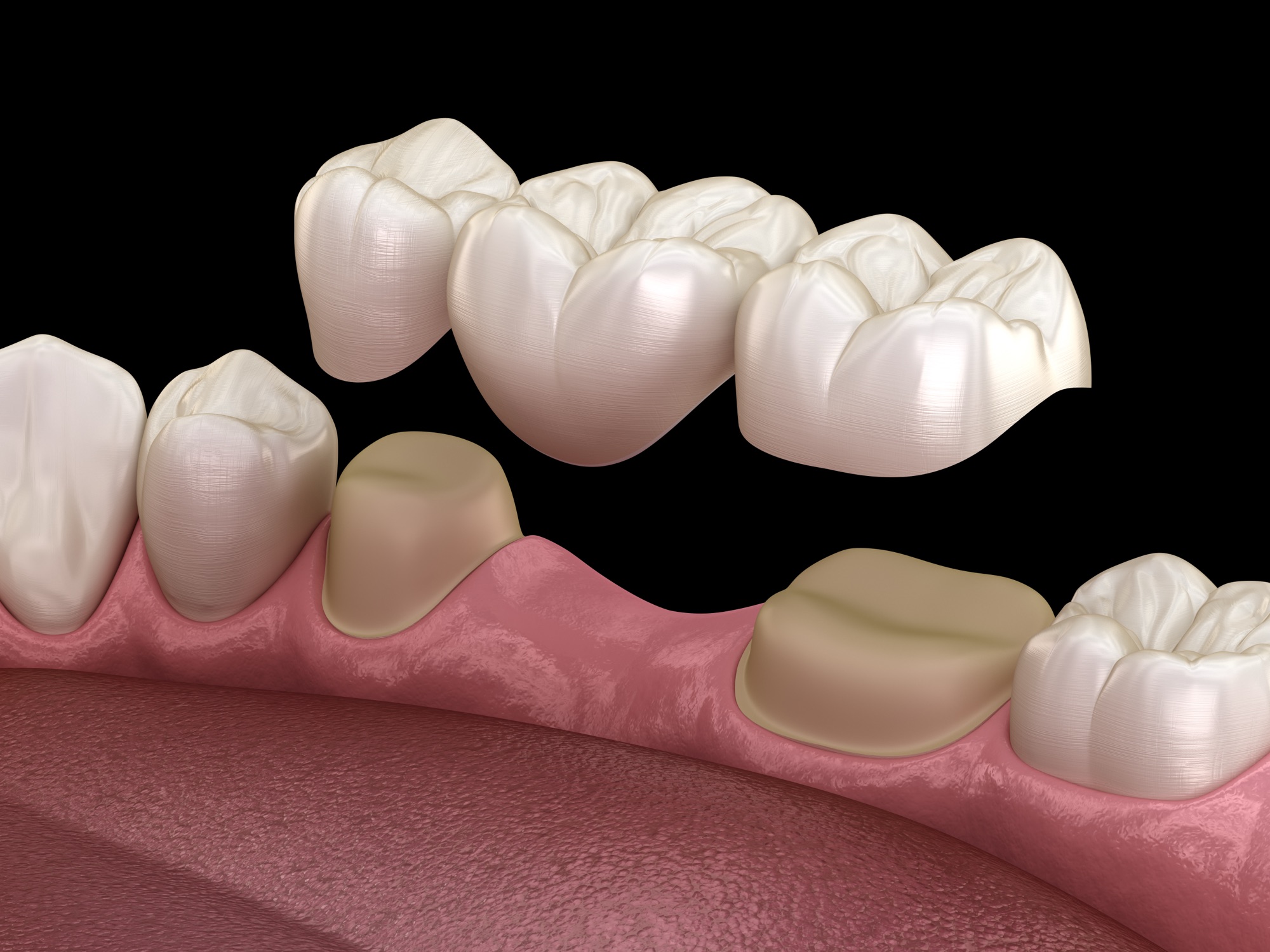 Illustration of a dental bridge
