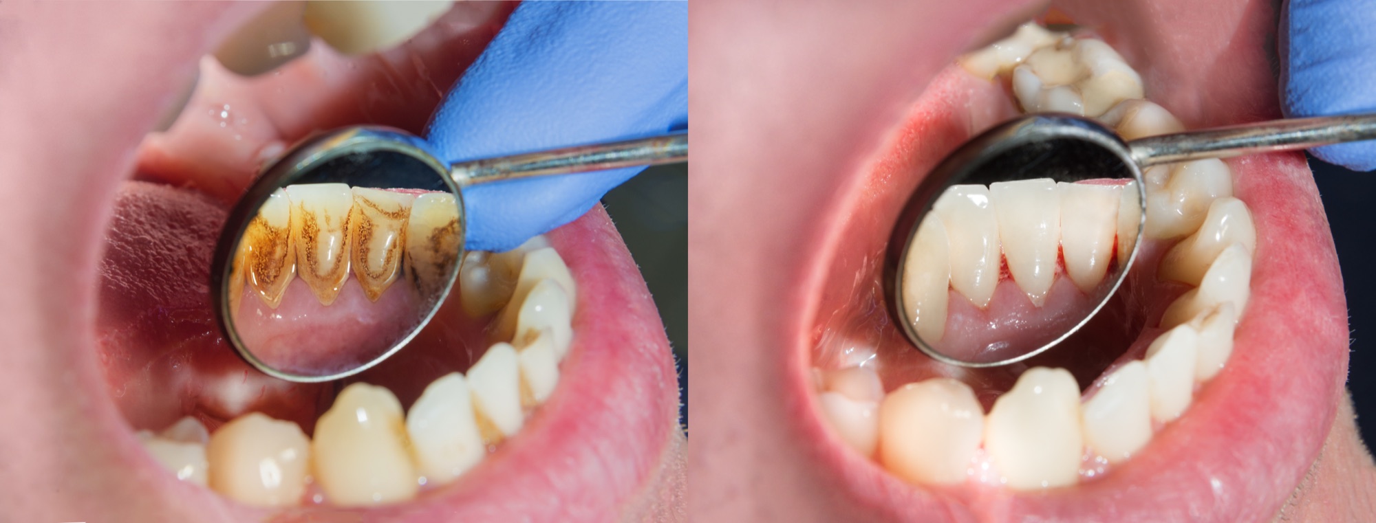 Before and after professional dental scaling