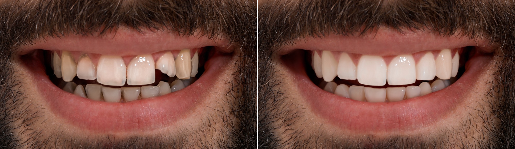 Dental treatment before and after result