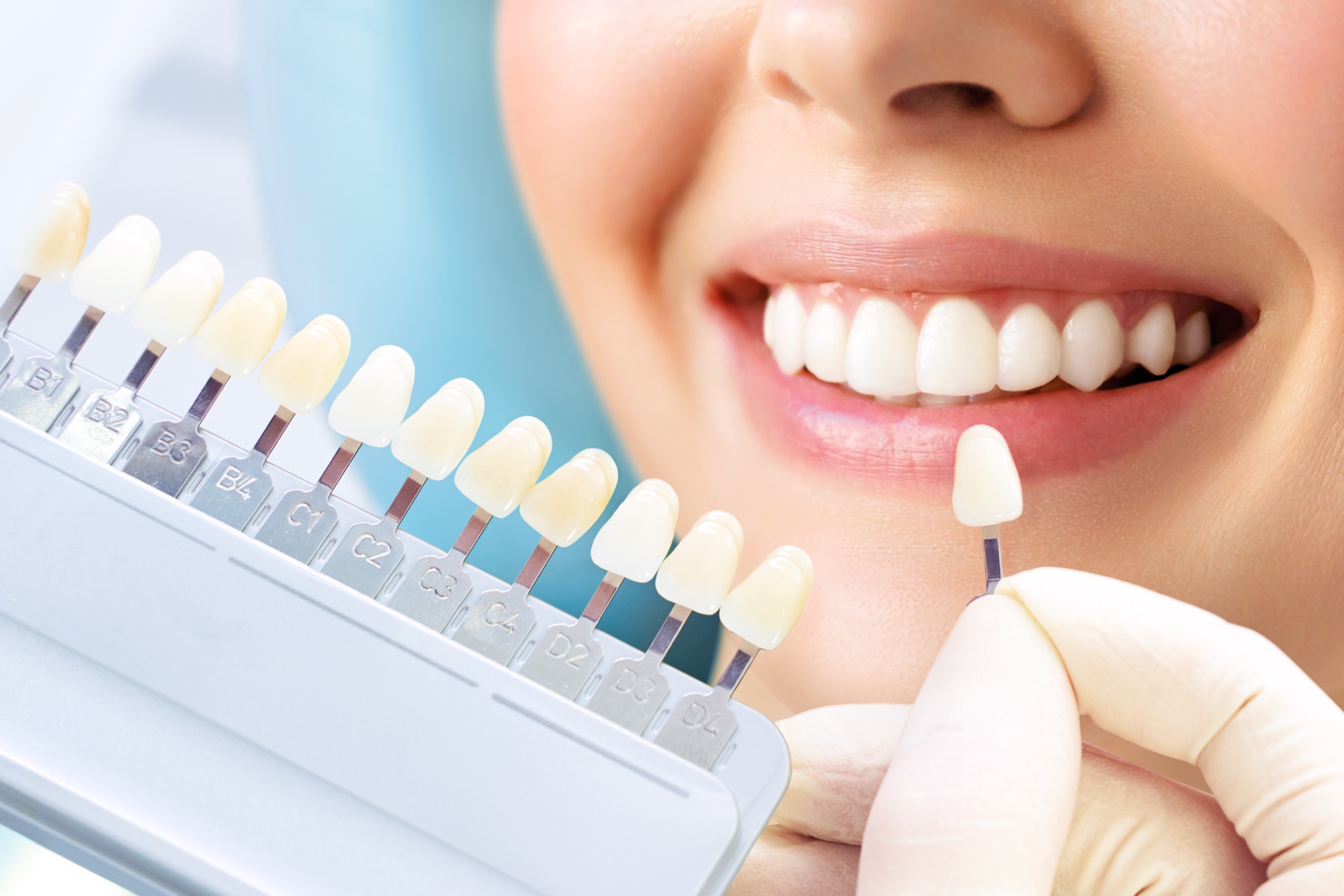 Teeth whitening shade assessment